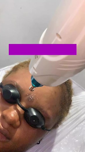 Laser spot removal is a safe and effective way to treat dark spots, sun spots, and hyperpigmentation. It works by targeting excess melanin in the skin, breaking it down so your body can naturally clear it away. With consistent sessions, you’ll notice a clearer, more even skin tone—no harsh chemicals, just results.” For booking and enquirer send us a dm ☎️07039242962 #scarletglowbeautyspa #lasertattooremoval #laserhairremoval #spotremoval#laserscarremoval