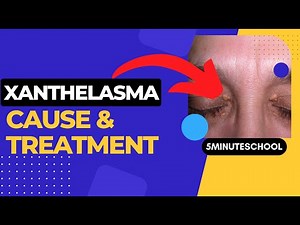 XANTHELASMA - CAUSES, ETIOLOGY, APPEARANCE, DIAGNOSIS AND TREATMENT