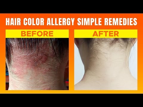 Hair Color Allergy Treatments (Causes, Symptoms, Treatments, and Prevention) by Yellow Heart