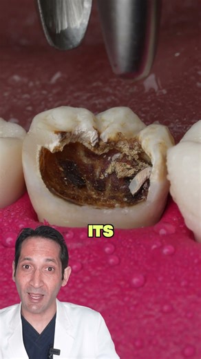 Tooth Extraction Instruction