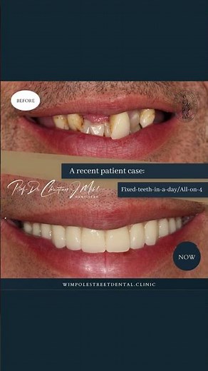 Fixed Teeth in a Day | Before and After