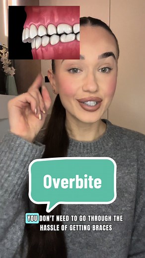 Overbite Treatment with Invisalign: A Convenient Solution