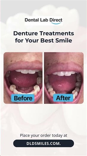 Denture treatments for your best smile #dentallabdirect #dentist #dentalissue