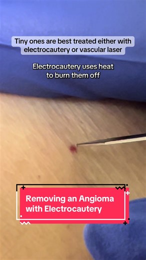 How to remove an #angioma with #electrocautery. #cherryangioma #cherryangiomas #hemangioma