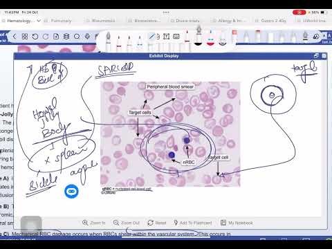 UWorld Heme-Onc 🧠 | No spleen? Say hello to Howell–Jolly bodies.