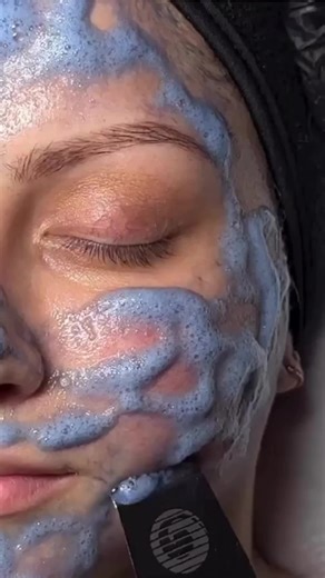 Blue foamy goodness with our Aquafuse Tech Peel! Remove with the bt-micro to achieve an advanced skin exfoliation and smoothing. 🎥 IG/layersbylesley