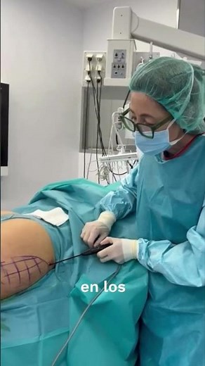 Quantum RF in Lipedema treatment - Dr. Ana Torres Institute Barcelona