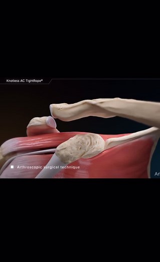 Reparación de luxación acrómionclavicular