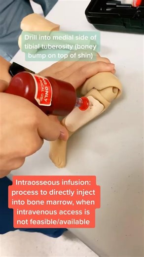 Interosseous (IO) Insertion ￼#emergencymedicine #ems #paramedic #meded