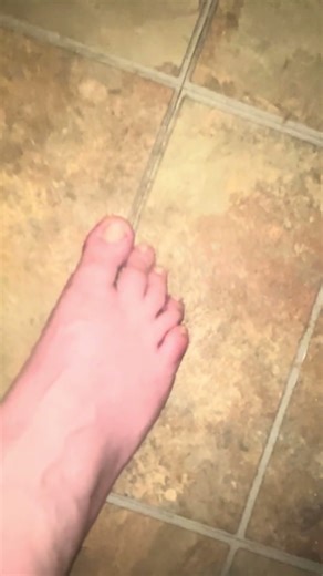 Overweight and overworked. This is what it does to your feet. No arch left. Bone spurs, arthritis..