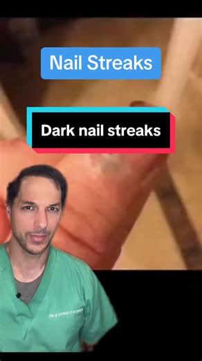 Understanding Nail Streaks: Benign or Melanoma?