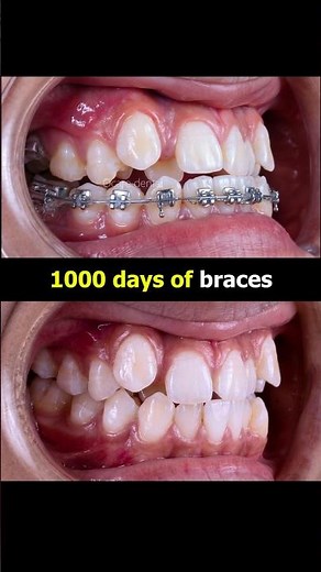 1000 days of braces process: From extremely crowded teeth to aligned #braces #orthodontics #dentist