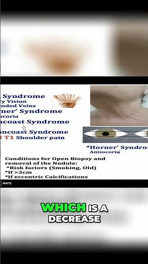 Horner's Syndrome: Understanding Ptosis, Miosis, Anhidrosis #shorts