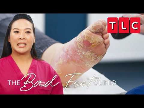 Extreme Pedicures | The Bad Foot Clinic | TLC