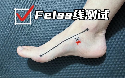 自我评估扁平足，Feiss线测试法 | 网上跟练需谨慎！