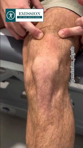 💥Inverted J Sign💥 #emission #anatomy #physicaltherapy #specialtests #kneepain