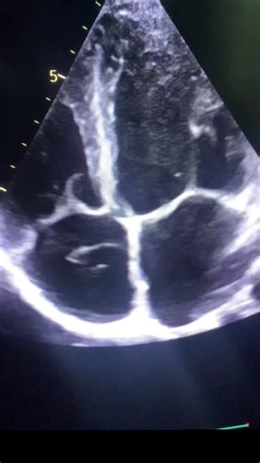 Understanding Septal Bounce and Chiari Network in Echocardiograms