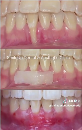 Gums Grafting Surgery: Procedure, Costs, and Recovery