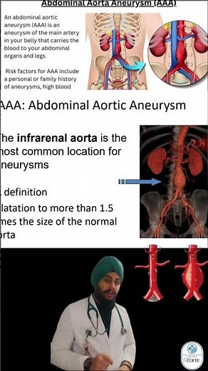 Abdominal Aortic Aneurysm (AAA) #medmint #medicalstudent #medicine #clinicalcase #education