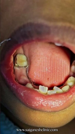 Protecting Your Child’s Smile- Space Maintainer