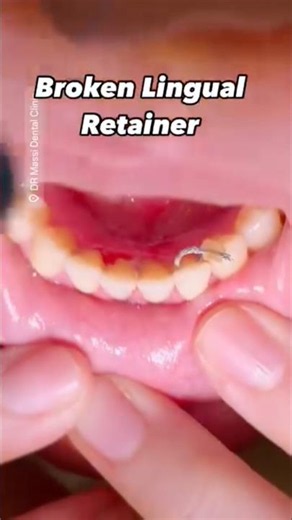 BROKEN LINGUAL RETAINER 🦷😬