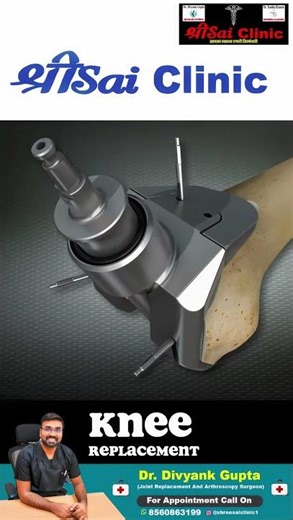 Knee Replacement Full Guide | Causes, Treatment & Results | Dr. Divyank Gupta