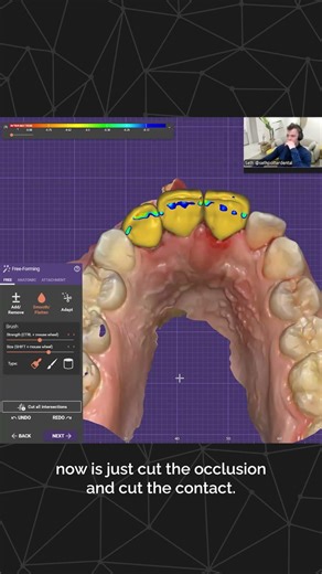 exocad Training Session - Seth Potter