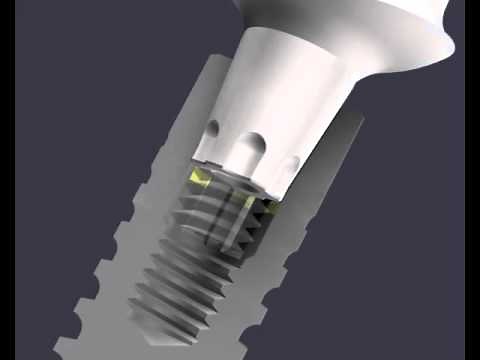 Ankylos® C/X – Implant interior | Dentsply Sirona
