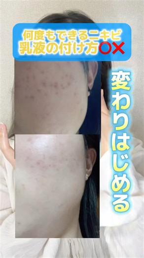 何度もできるニキビ 乳液の付け方✨＊クリームも☺️ #ニキビ改善 #ニキビ #ニキビケア #美容 #スキンケア #ニキビ跡