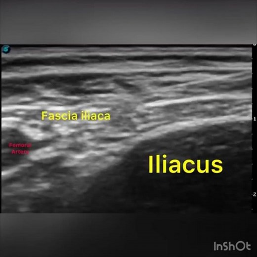 Ultrasound guided fascia iliaca block!!