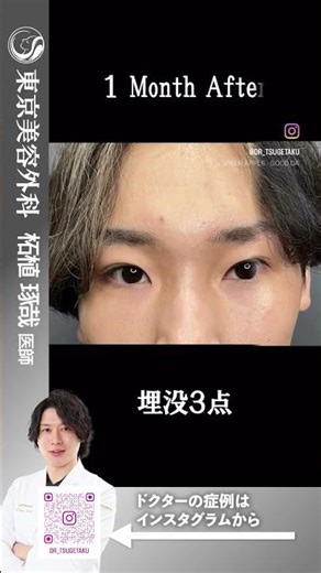 埋没で印象深い目元に！ #shorts #ドクターa #美容 #東京美容外科 #整形 #麻生泰 #美容整形 #赤坂 #埋没 #二重 #コンプレックス