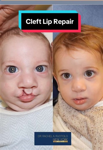 Hi 👋🏼 everyone! Watch the following video 🎥 cataloging THREE #cleftcutie’s - all with different INCOMPLETE cleft lips. It is so very important for parents to see and understand the many changes that occur to the lip, nose and scar during the months and years following their child’s cleft repair. The lip is often pink and firm for many months after the surgery. I try my best to reassure parents along the way, as SO many changes happen over time. Some changes will require intervention, and othe