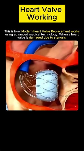 How Modern Heart Valve Replacement Works ❤️ | Advanced Treatment for Stenosis Explained