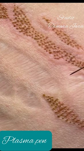 16K views · 132 reactions | Aquí les dejo algunos clips de contracción y cierre de estrías con nuestra técnica de Plasma pen ✅#plasmapenchile #plasmapencurso #microbladingchile #bellezachilena | Studio Tamara Jara | Facebook