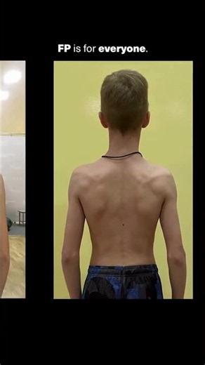 Fixing Scapular Dyskinesis: A Parent’s Guide to Future-Proofing
