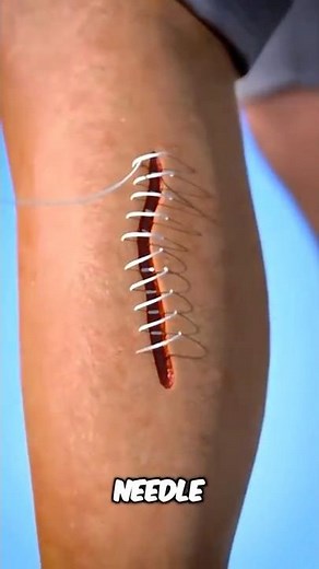 What Really Happens When You Get Stitches 😱