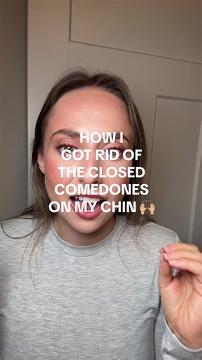 How I Got Rid of Closed Comedones on My Chin
