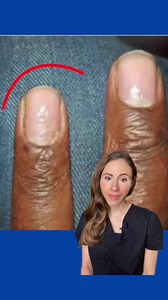 Hand eczema might be messing with your nails. Ridges on the nails and misshapen nails can occur with hand eczema. The inflammation from the eczema can disrupt the connection between the cuticle & the nail plate, allowing debris to enter the nail matrix & interfere with nail growth. Triggers for hand eczema include frequent hand washing, harsh soaps, wet work/doing dishes by hand, & contact with nickel. Avoiding triggers & protecting the hands with gloves is key for preventing flares. Moisturizer