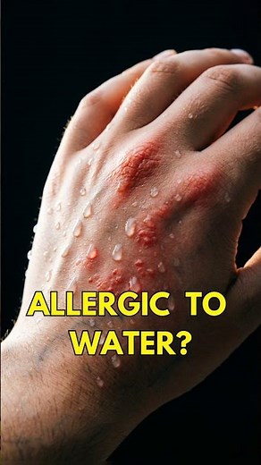 Allergic to water… and it’s real.