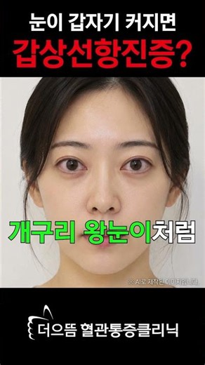 눈이 튀어나오는 증상… 갑상선 때문일 수 있습니다 #갑상선암 #안구돌출 #갑상선항진증