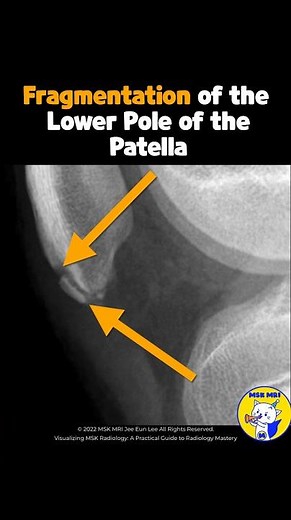(Fig 4-B.19) Sinding-Larsen-Johansson Syndrome