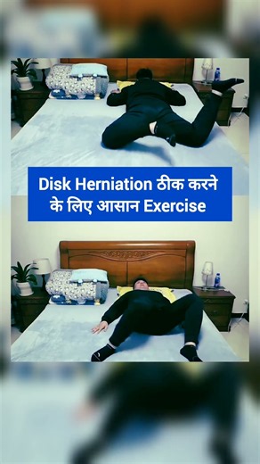 Best Exercise For Disk Herniation