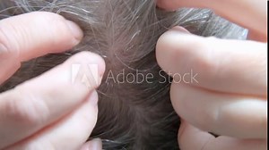 woman scratching head due to dandruff, showing visible flakes on shoulders, discomfort and social impact of condition, need for treatment, flaking and itching