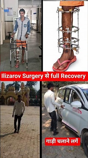 Sintu जी का ilizarov Surgery से इलाज पूरा full Recovery in Tibia bone fracture infected and nonunion