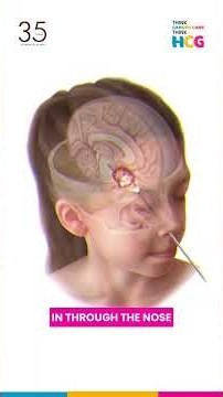 Pituitary Tumour: How It Affects Hormones & Vision | Dr. Riddhijyoti Talukdar | HCG Cancer Hospital