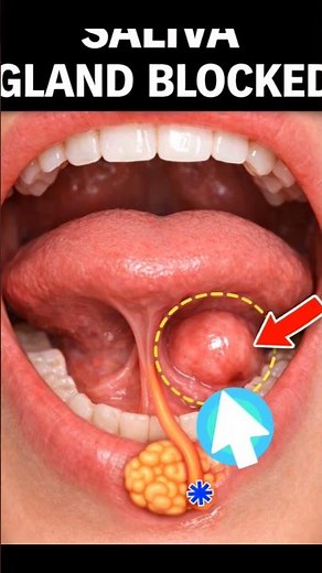 Lump Under Your Tongue? Don’t Ignore This warning ⚠️