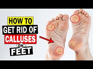 How to Remove Calluses on Feet with Home Remedies