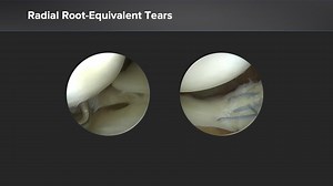 My Approach to Ramp Lesions, Radial Tears, and Meniscal Root Tears