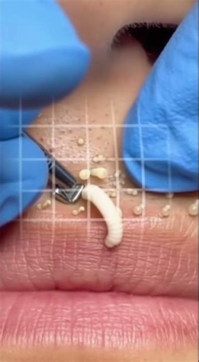 Extreme Pimple Popping & Dermatology Extractions | The Ultimate Satisfying Content(22) #short #acne