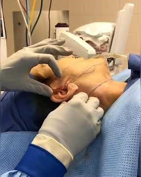 Lower Facelift - Before, in the OR, and After- Dr. Anthony Youn